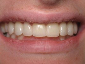 Prosmiles General and Cosmetic Dentistry | Oral Cancer Screening, Cosmetic Dentistry and Crowns