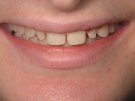 Prosmiles General and Cosmetic Dentistry | Inlays amp Onlays, Sports Mouthguards and Dental Fillings