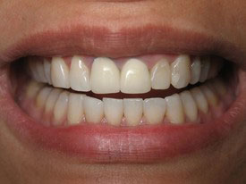 Prosmiles General and Cosmetic Dentistry | Periodontal Treatment, Teeth Whitening and Root Canals