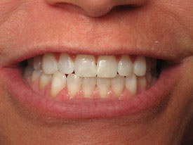 Prosmiles General and Cosmetic Dentistry | Teeth Whitening, Ceramic Crowns and Dental Bridges