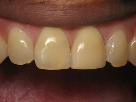 Prosmiles General and Cosmetic Dentistry | Dentures, Extractions and Dental Sealants