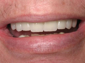 Prosmiles General and Cosmetic Dentistry | Dental Sealants, Laser Dentistry and Root Canals