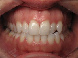 Prosmiles General and Cosmetic Dentistry | Implant Restorations, TMJ Disorders and Root Canals