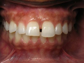 Prosmiles General and Cosmetic Dentistry | Dentures, Crowns and All-on-6