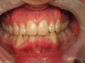 Prosmiles General and Cosmetic Dentistry | Sports Mouthguards, Oral Exams and Preventative Program