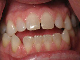 Prosmiles General and Cosmetic Dentistry | Inlays  amp  Onlays, Veneers and Fluoride Treatment
