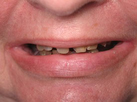 Prosmiles General and Cosmetic Dentistry | Dental Bridges, Oral Exams and Veneers