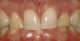 Prosmiles General and Cosmetic Dentistry | Dental Fillings, Preventative Program and Extractions