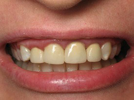 Prosmiles General and Cosmetic Dentistry | Dental Sealants, ZOOM Whitening and Dental Fillings